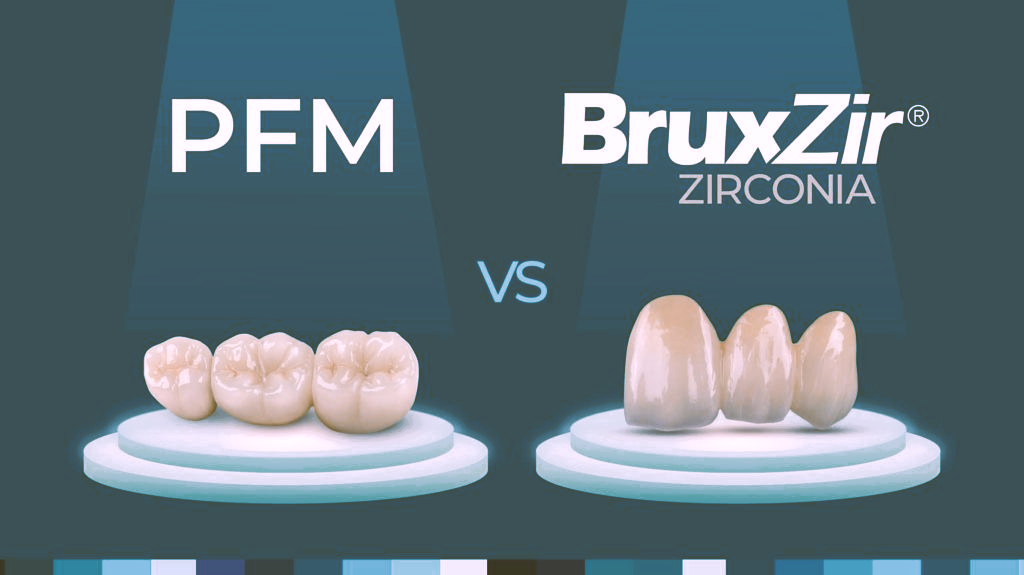 Dental Crowns in Gurgaon