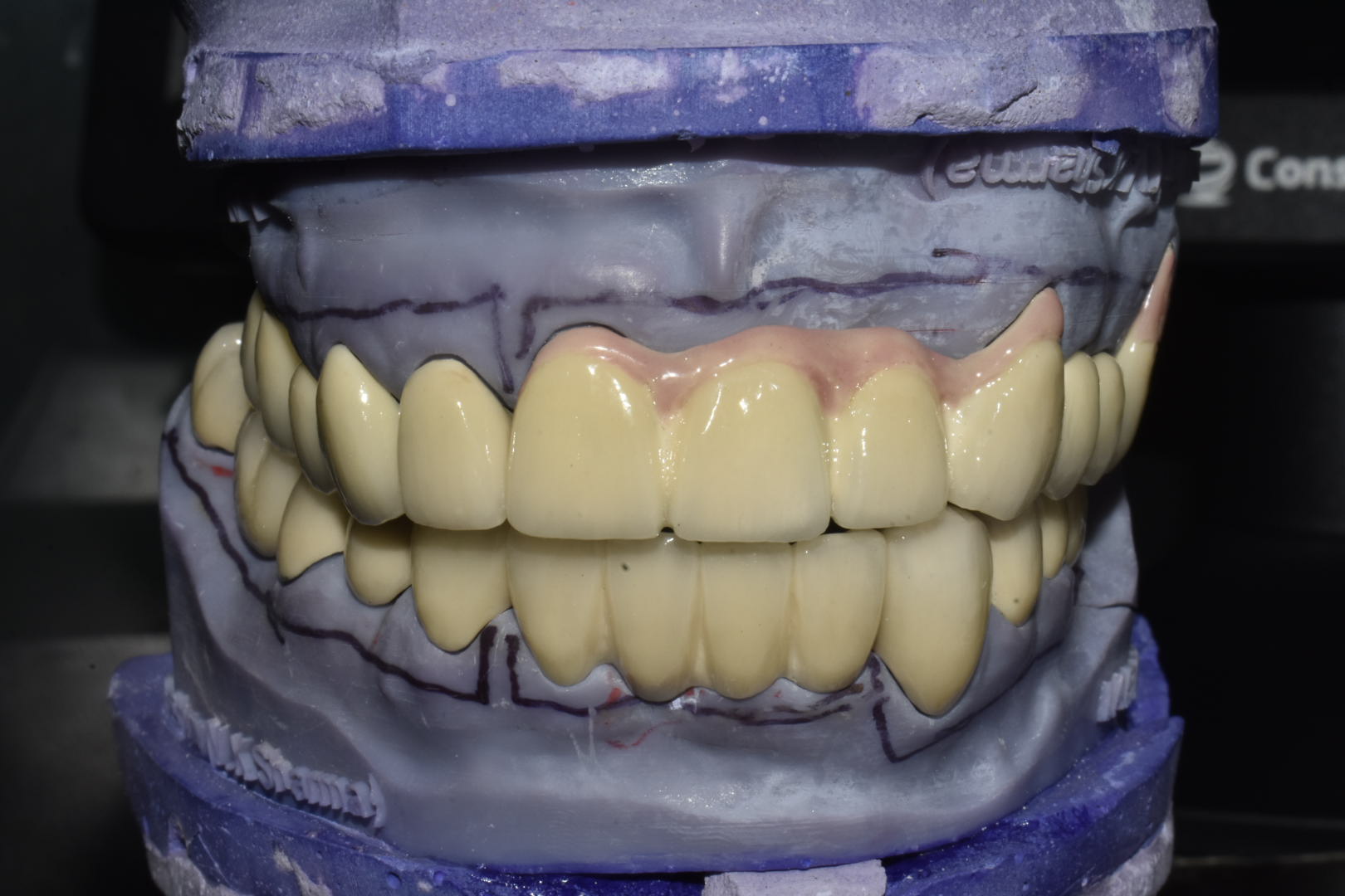 Full Mouth Rehab Capping in Gurgaon