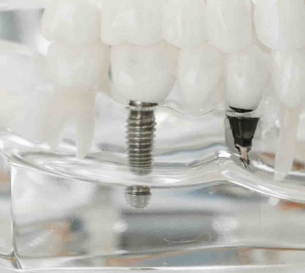 DENTAL IMPLANT