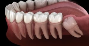 Wisdom Tooth
